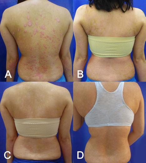 (圖2A)基線(細(xì)胞移植前);(圖2B)首次輸注后 30 天;(圖C2) 121 天后;(圖2D)231 天后。 (圖2A)基線(細(xì)胞移植前);(圖2B)首次輸注后 30 天;(圖C2) 121 天后;(圖2D)231 天后。