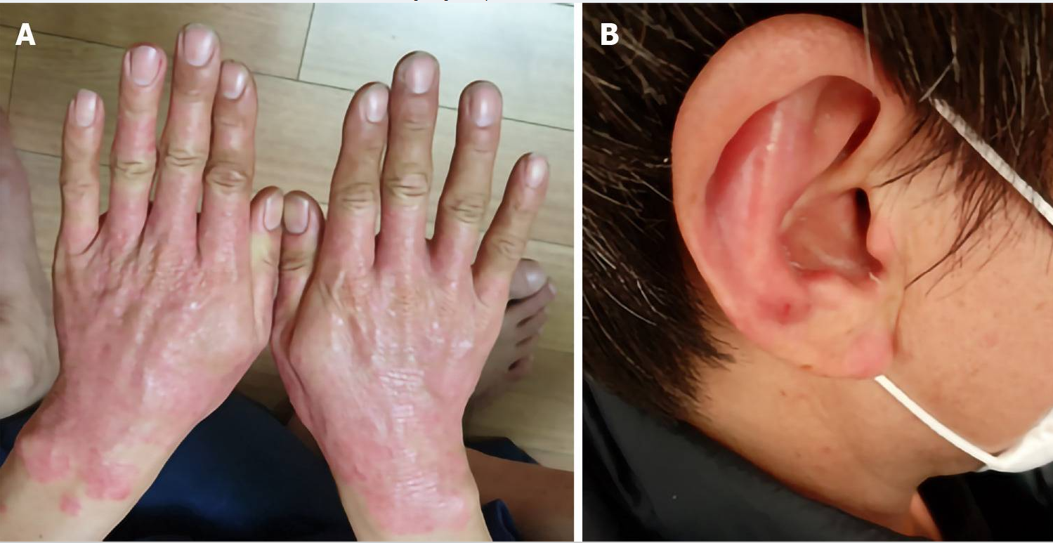 圖1A:移植微創(chuàng)臍帶間充質(zhì)干細(xì)胞(MM-UC-MSCs)前手部及腕部銀屑病病變部位; 圖1B:移植臍帶間充質(zhì)干細(xì)胞前的耳朵。 治療前銀屑病病變部位