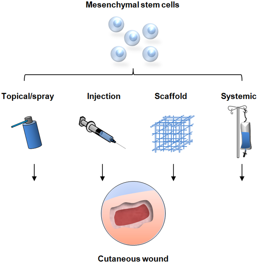 間充質(zhì)干細(xì)胞的治療方式有哪些—從傳統(tǒng)細(xì)胞移植到現(xiàn)代生物技術(shù)的應(yīng)用 間充質(zhì)干細(xì)胞的治療方式有哪些—從傳統(tǒng)細(xì)胞移植到現(xiàn)代生物技術(shù)的應(yīng)用