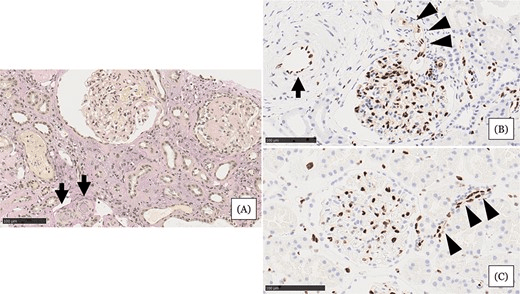 圖1:住院第 31 天的腎臟活檢結果。 圖1:住院第 31 天的腎臟活檢結果。