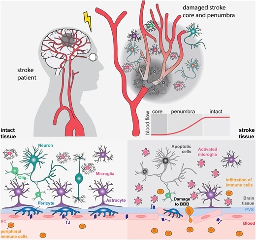 圖1：中風的病理生理學