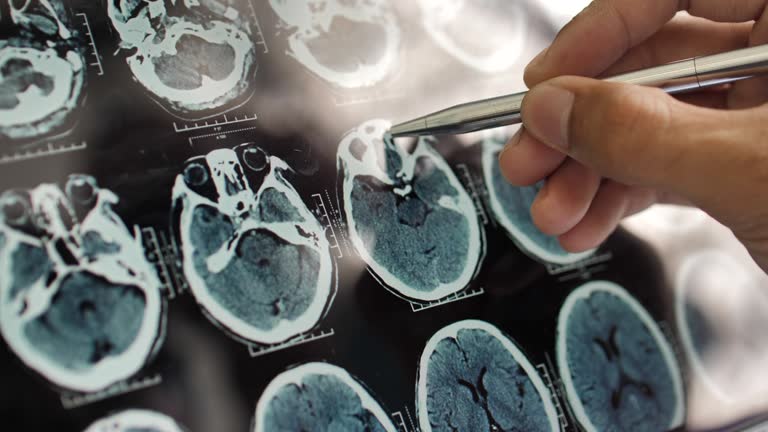 事關神經退行性疾病，干細胞在治療神經退行性疾病的療效、倫理、安全等問題的綜述