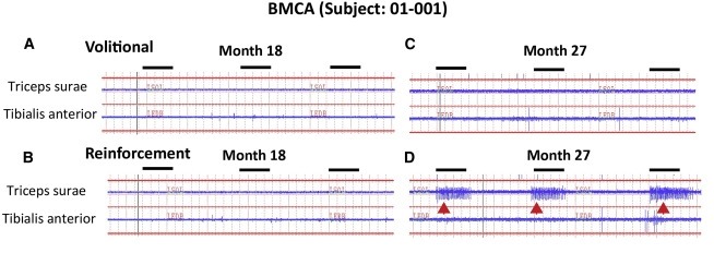 圖2:患者1腦運動控制評估(BMCA)和EMG評估 圖2:患者1腦運動控制評估(BMCA)和EMG評估