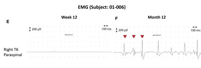 圖3:患者2腦運動控制評估(BMCA)和EMG評估 圖3:患者2腦運動控制評估(BMCA)和EMG評估
