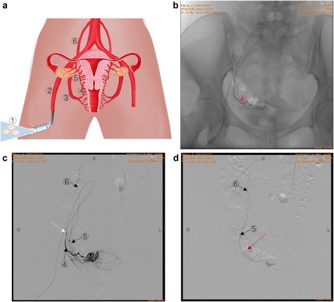 圖 2:通過卵巢?動脈精確輸注 hAEC。 圖 2:通過卵巢?動脈精確輸注 hAEC。