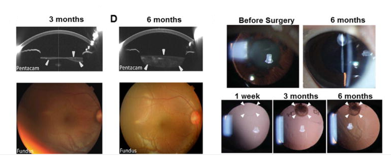 手術后六個月,囊袋充滿了再生晶狀體組織 手術后六個月,囊袋充滿了再生晶狀體組織