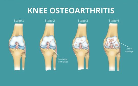 干細胞治療膝骨關節炎：患者臨床癥狀顯著改善，減少炎癥，消除疼痛