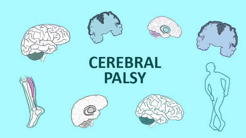 從步履蹣跚到穩健行走:干細胞技術如何重塑腦癱兒童平衡能力? 從步履蹣跚到穩健行走:干細胞技術如何重塑腦癱兒童平衡能力?