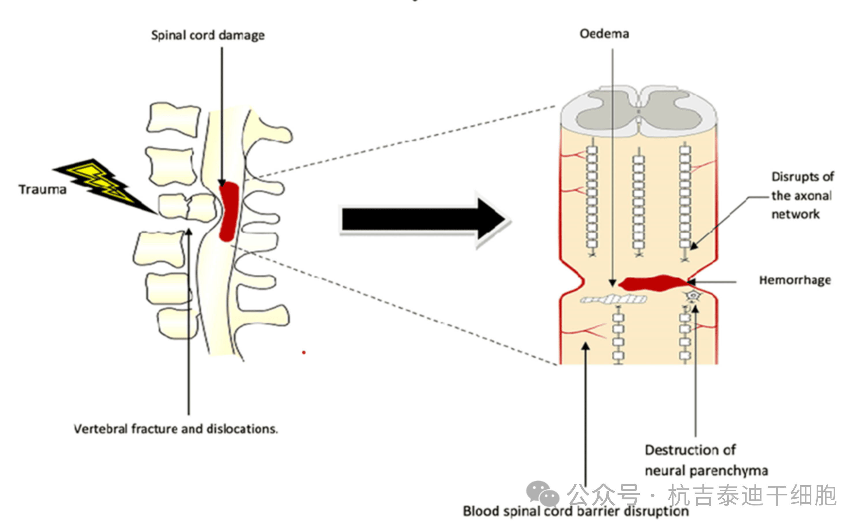圖1：原發(fā)性病變，該圖顯示了創(chuàng)傷的直接影響，包括椎骨骨折、脫位和脊髓損傷導致軸突斷裂、水腫、出血和神經(jīng)實質(zhì)破壞