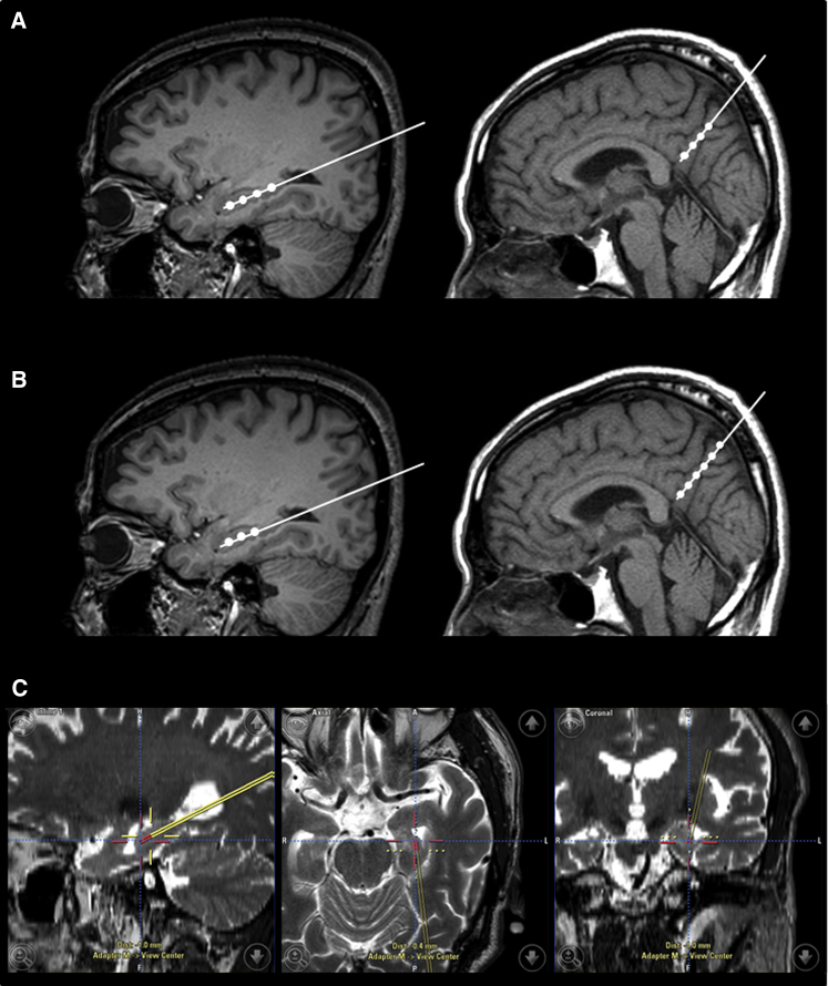 臍帶間充質干細胞的立體定向給藥