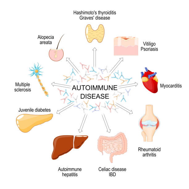 間充質(zhì)干細(xì)胞療法:一種在10種自身免疫性疾病中有前景的治療方法 間充質(zhì)干細(xì)胞療法:一種在10種自身免疫性疾病中有前景的治療方法