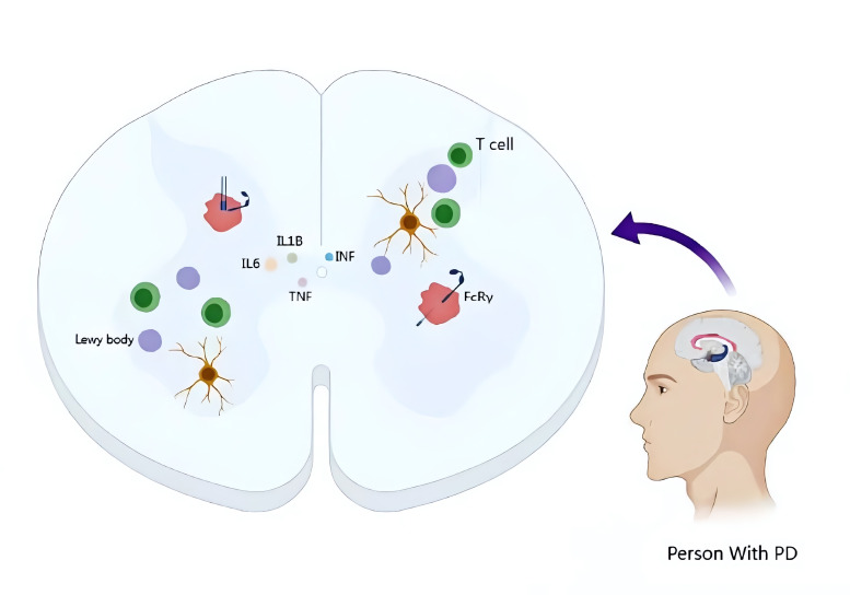 圖1:帕金森病的病理特征和神經炎癥的作用 圖1:帕金森病的病理特征和神經炎癥的作用