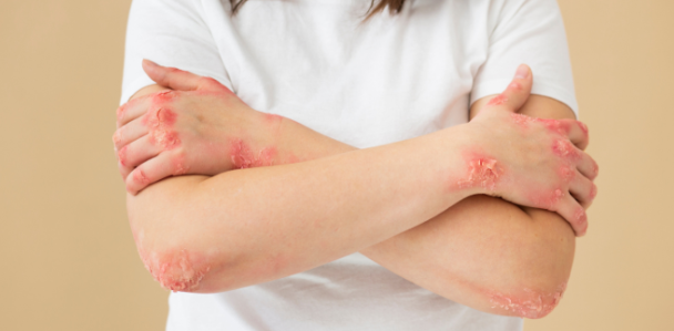 干細胞治療系統(tǒng)性紅斑狼瘡：如何實現(xiàn)從短期的疾病癥狀緩解到長期的多器官功能改善？