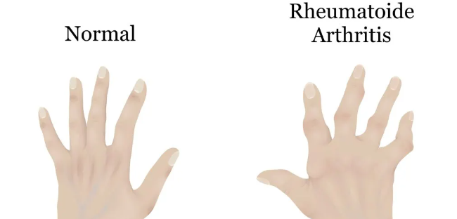 干細(xì)胞治療類風(fēng)濕關(guān)節(jié)炎：如何實(shí)現(xiàn)從短期關(guān)節(jié)功能改善到長(zhǎng)期的生活質(zhì)量提升？