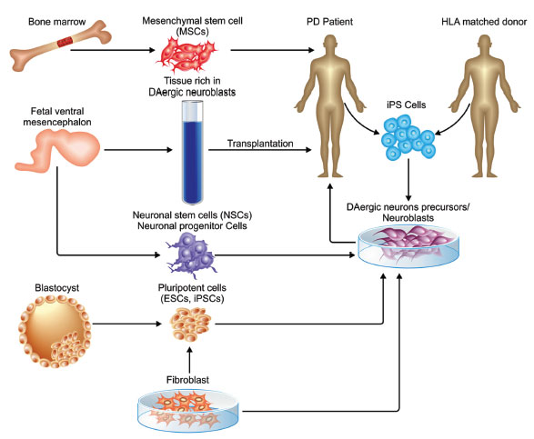 圖 (1)。不同類型的干細胞可用于帕金森病的修復。