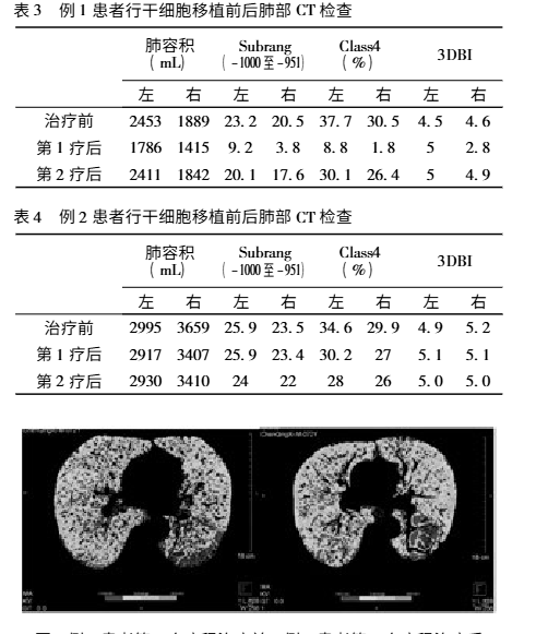 干細(xì)胞移植前后的肺部CT檢查對比 干細(xì)胞移植前后的肺部CT檢查對比