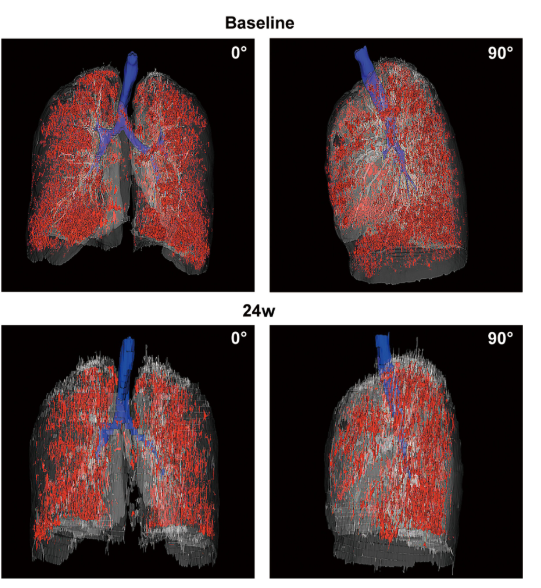 患者 #2902 自體 P63 細(xì)胞移植前和后 24 周連續(xù)肺部 CT 圖像的三維可視化。 患者 #2902 自體 P63 細(xì)胞移植前和后 24 周連續(xù)肺部 CT 圖像的三維可視化。