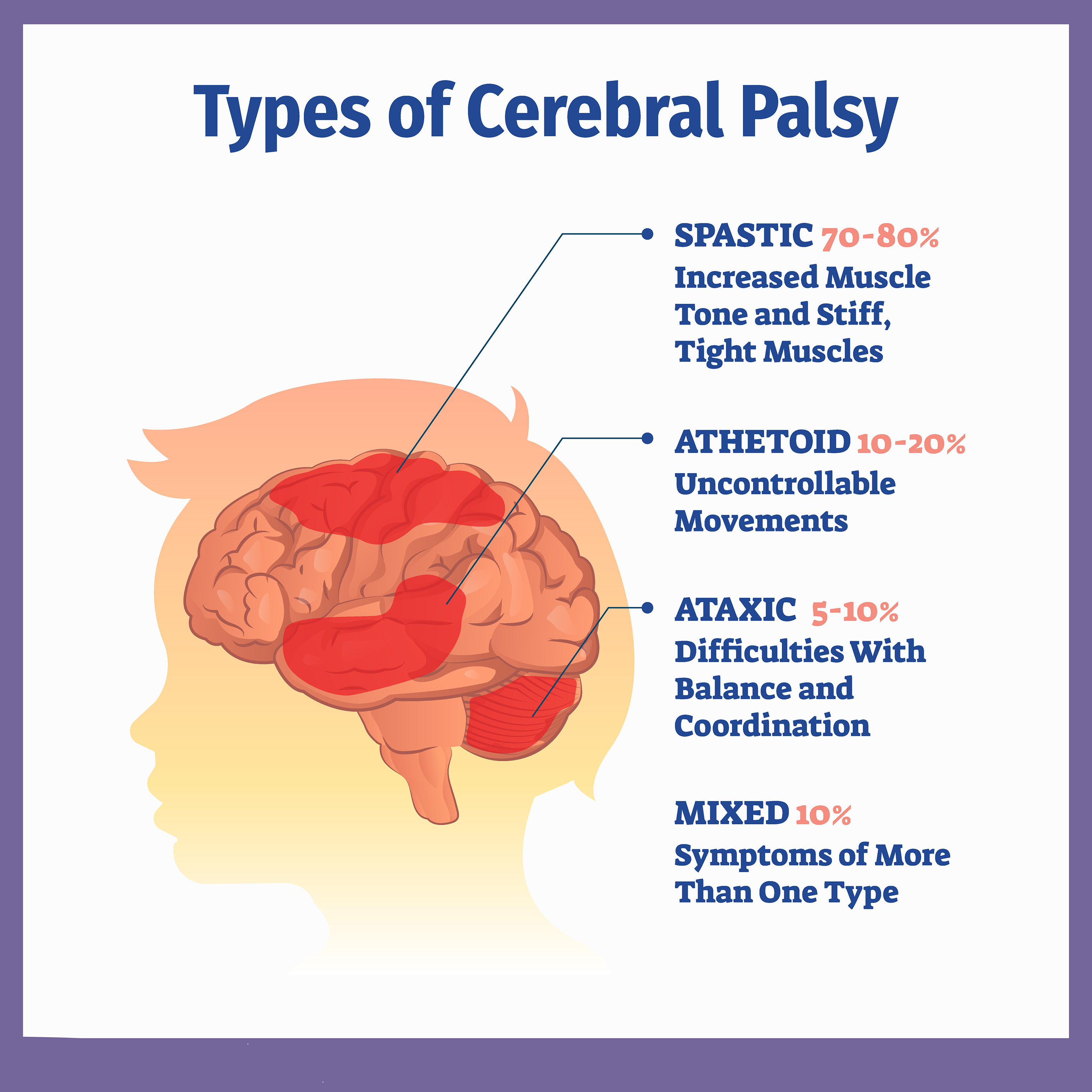 低劑量VS高劑量:不同劑量的干細(xì)胞治療腦癱哪個(gè)更加安全? 低劑量VS高劑量:不同劑量的干細(xì)胞治療腦癱哪個(gè)更加安全?