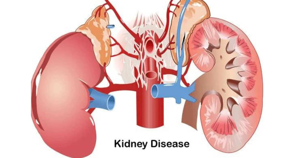 干細胞治療腎病:靜脈、動脈、皮質注射哪種更安全 干細胞治療腎病:靜脈、動脈、皮質注射哪種更安全