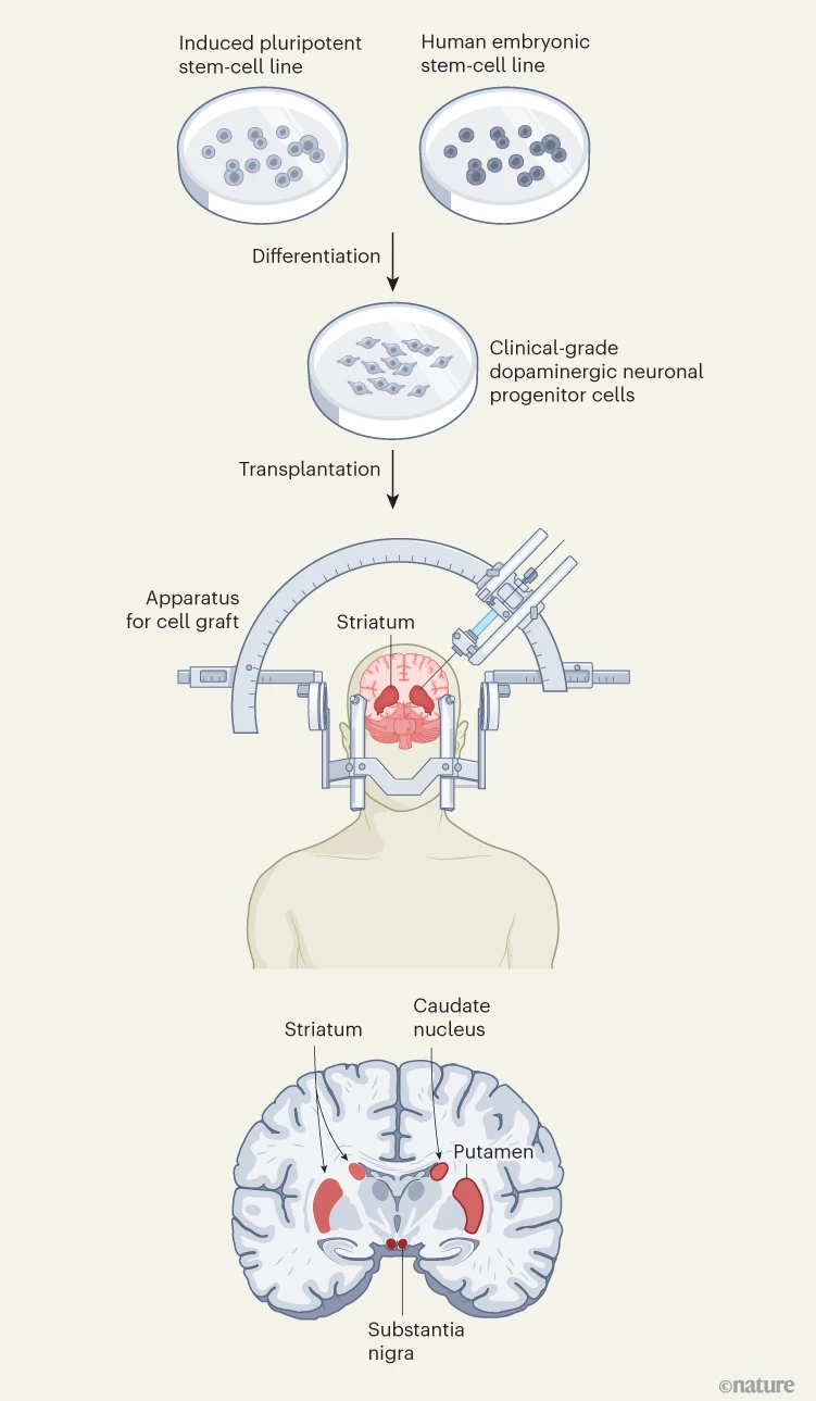 圖1:帕金森病的干細(xì)胞療法。 圖1:帕金森病的干細(xì)胞療法。