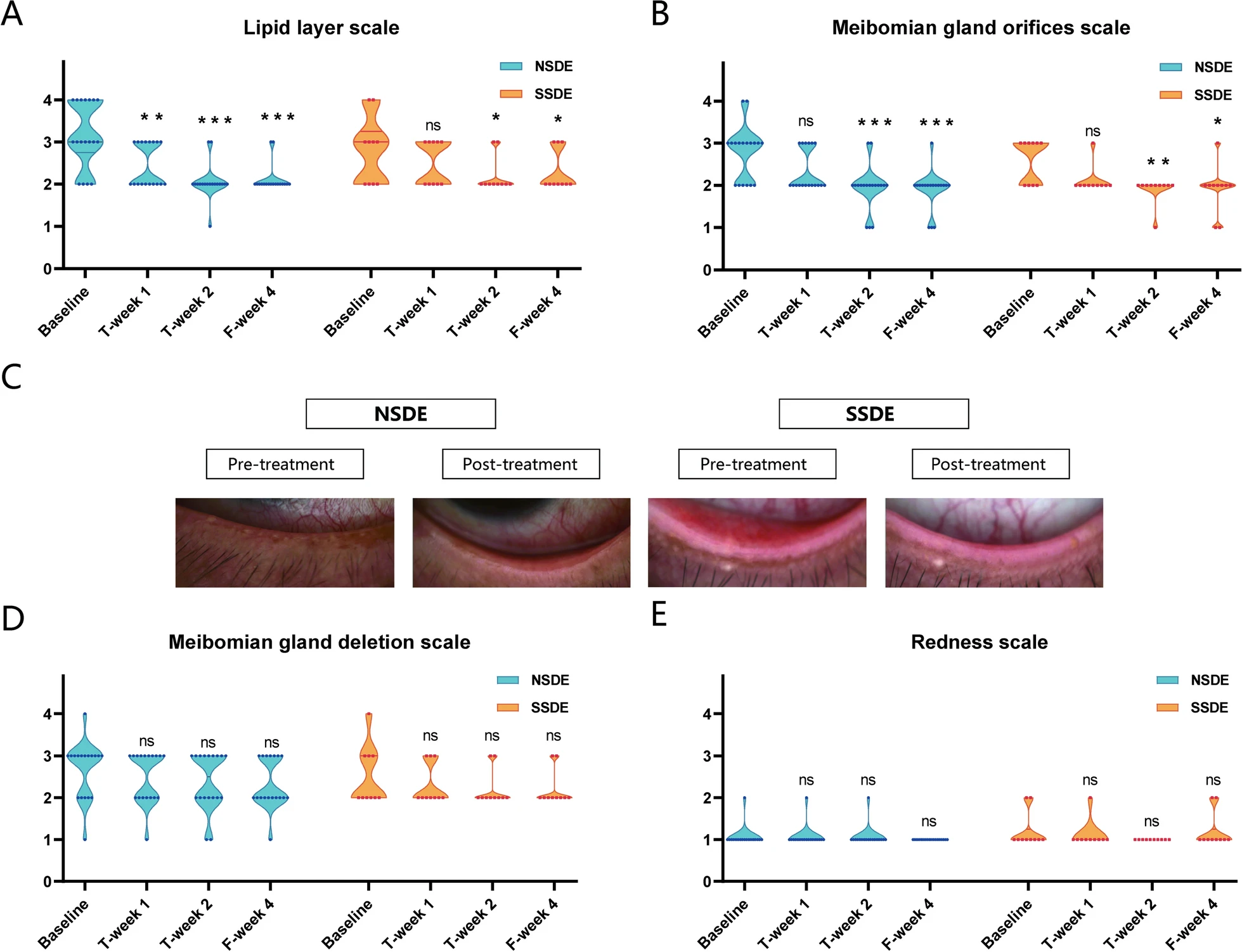 圖3:NSDE和SSDE組基線、T第1周、T第2周和F第4周的脂質(zhì)層、瞼板腺和紅斑量表。 圖3:NSDE和SSDE組基線、T第1周、T第2周和F第4周的脂質(zhì)層、瞼板腺和紅斑量表。