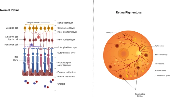 圖6：正常視網膜與受視網膜色素變性影響的視網膜的比較。