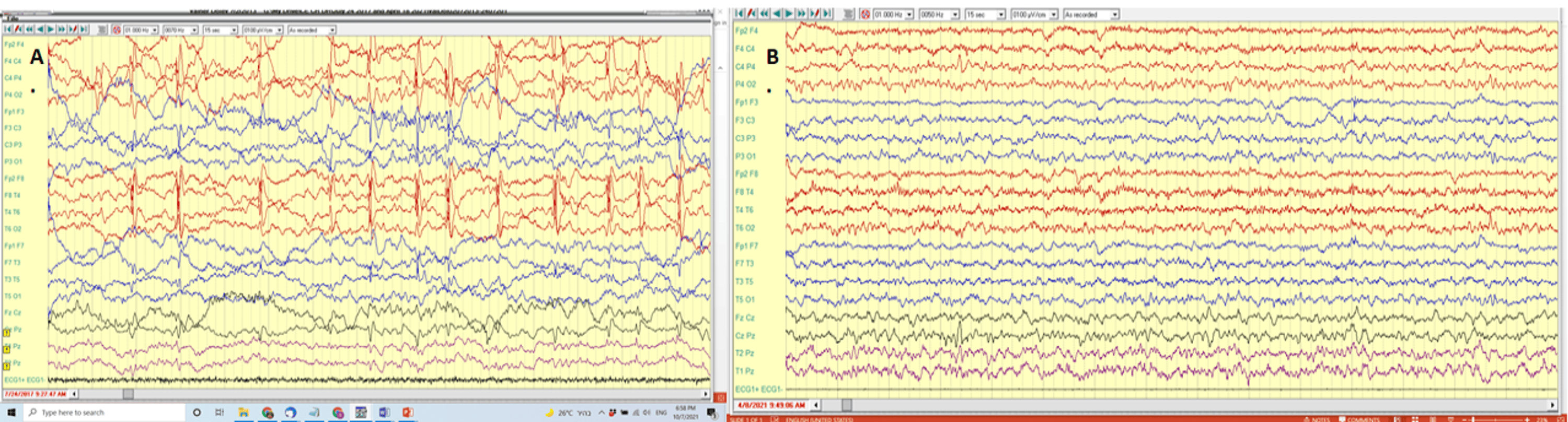 圖1：alloMSCT#1前后的腦電圖結(jié)果