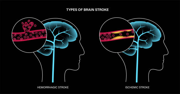從癱瘓到復(fù)?。∩窠?jīng)干細(xì)胞療法5大機(jī)制如何促進(jìn)中風(fēng)后的大腦修復(fù)？