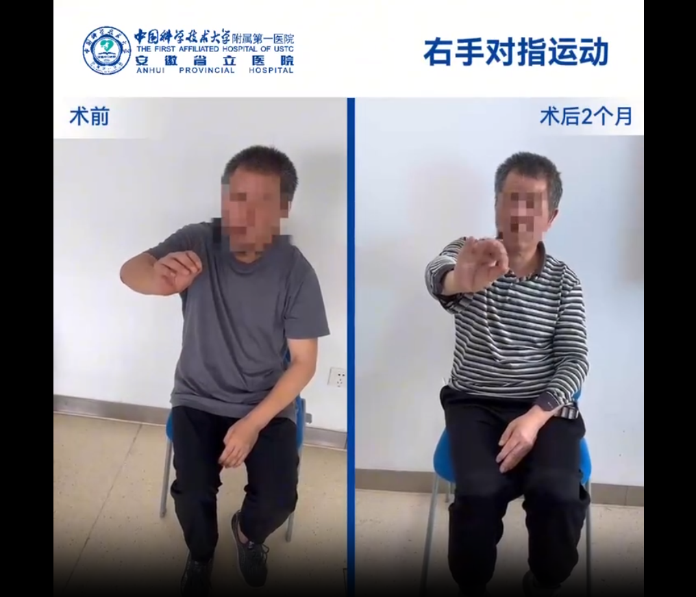 國(guó)內(nèi)誘導(dǎo)多能干細(xì)胞療法新突破:首例早發(fā)型帕金森病成功給藥,當(dāng)天即可行走 國(guó)內(nèi)誘導(dǎo)多能干細(xì)胞療法新突破:首例早發(fā)型帕金森病成功給藥,當(dāng)天即可行走