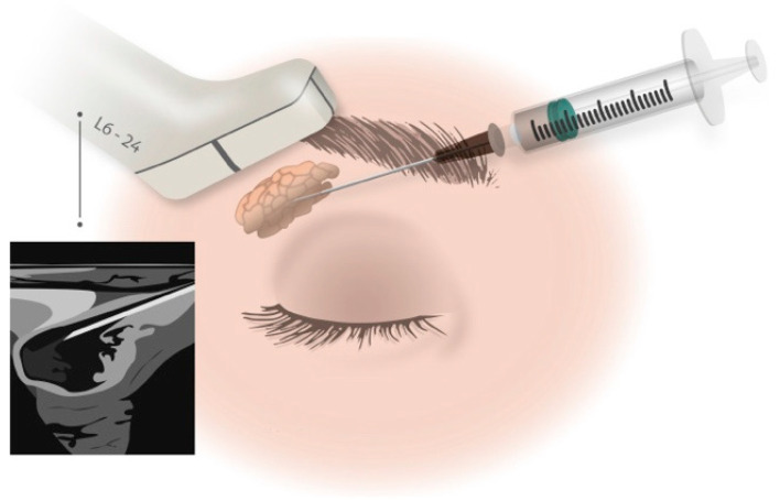 圖1：在超聲引導下向淚腺注射藥物。