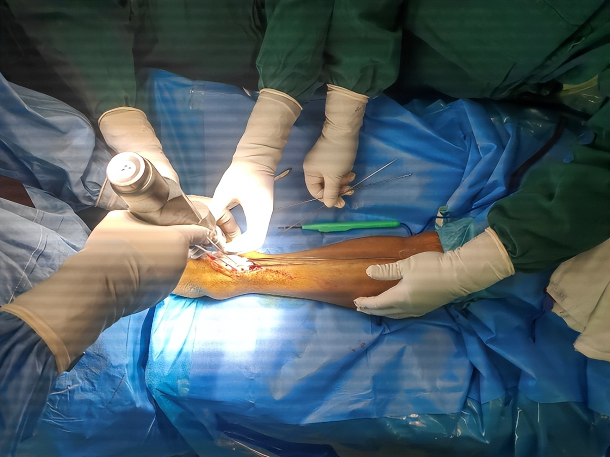 術中截骨導板輔助下精準截骨并安放假體 術中截骨導板輔助下精準截骨并安放假體