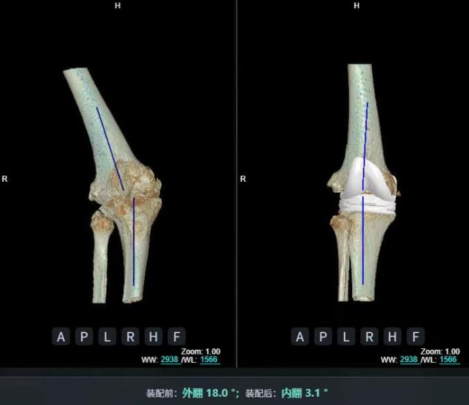 AI精準關節置換 AI精準關節置換