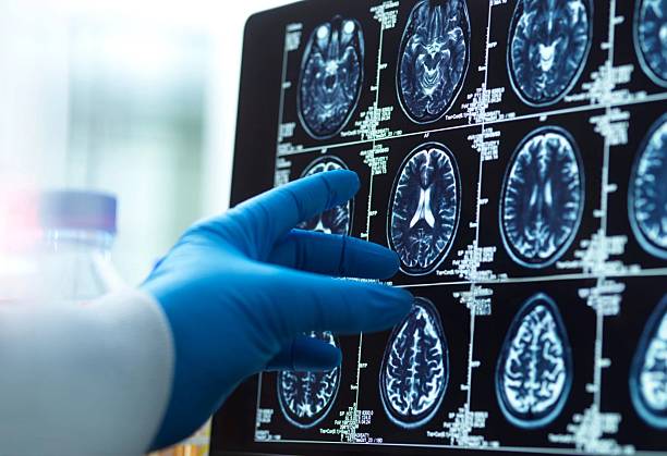 神經干細胞移植十大常見問題解答:從原理到術后護理全知道 神經干細胞移植十大常見問題解答:從原理到術后護理全知道