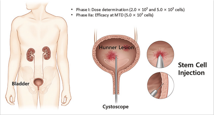 間質性膀胱炎臨床試驗 間質性膀胱炎臨床試驗