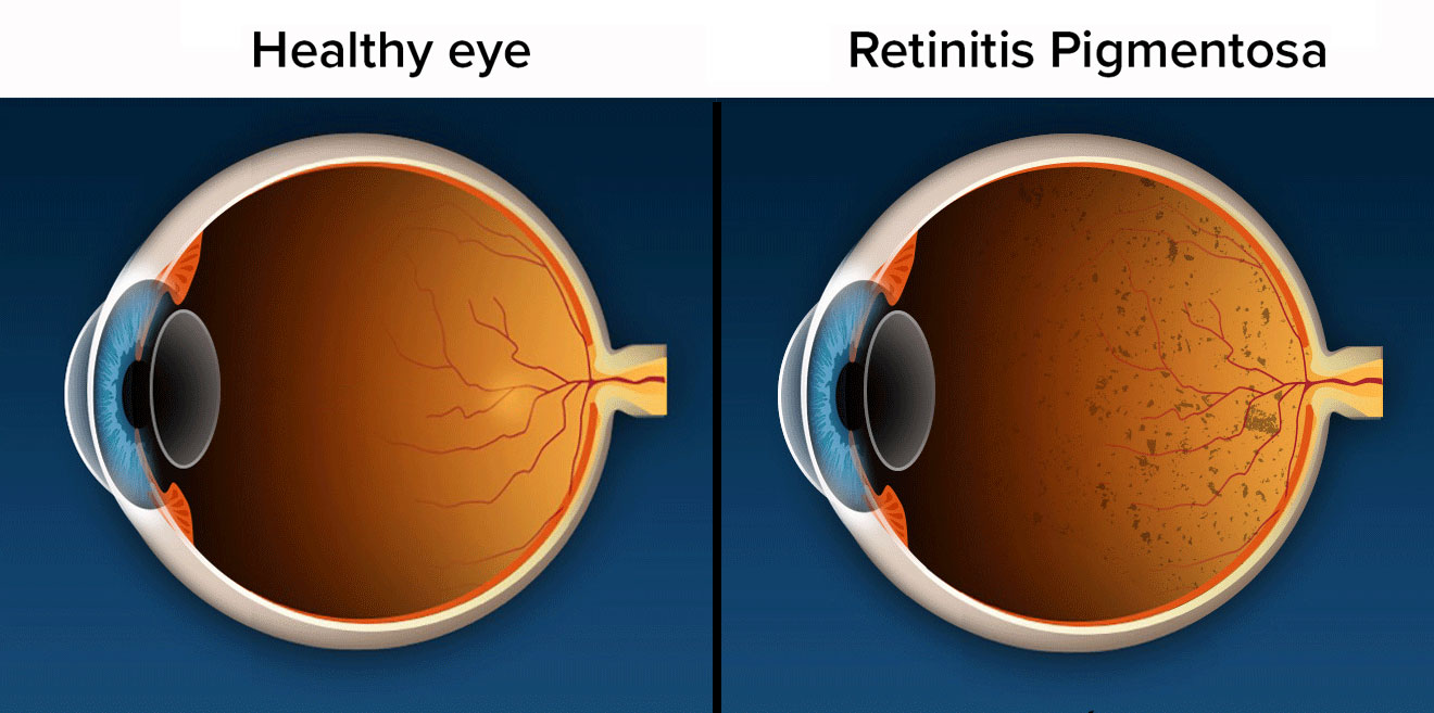 視網膜色素變性 視網膜色素變性
