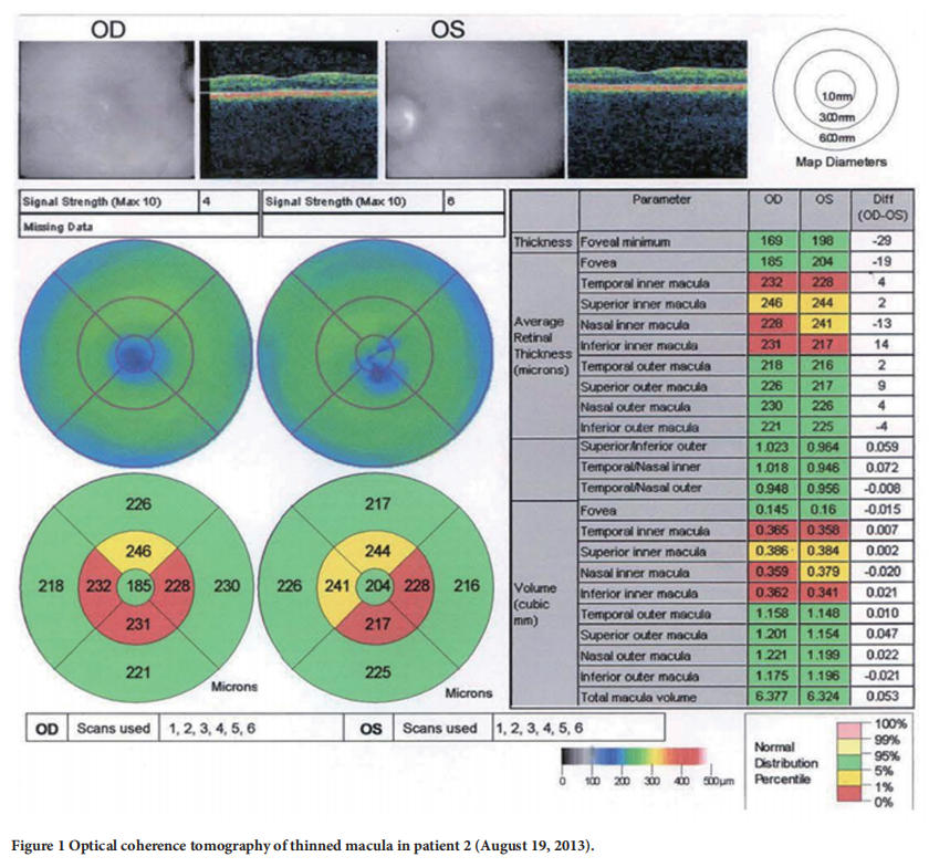 遺傳性視神經(jīng)病變臨床試驗(yàn) 遺傳性視神經(jīng)病變臨床試驗(yàn)