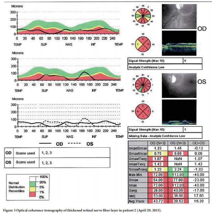 遺傳性視神經(jīng)病變臨床試驗(yàn) 遺傳性視神經(jīng)病變臨床試驗(yàn)