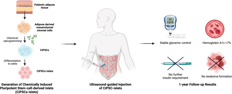 圖示：?通過將患者脂肪組織提取的間充質干細胞化學重編程為誘導多能干細胞并分化為胰島，再注射入腹直肌前鞘。