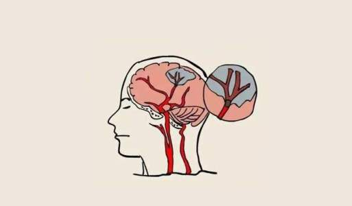 中風(fēng)后的腦損傷，真的能被干細(xì)胞療法逆轉(zhuǎn)嗎？