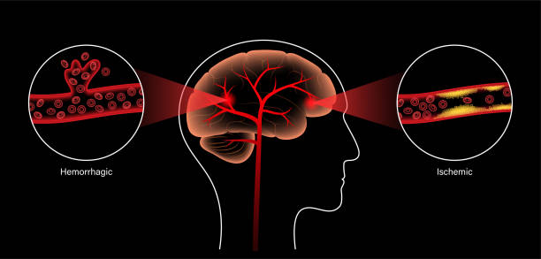 臍帶干細胞靜脈注射治療腦卒中？Ⅰ期人體研究結果公布：臨床顯示安全有效